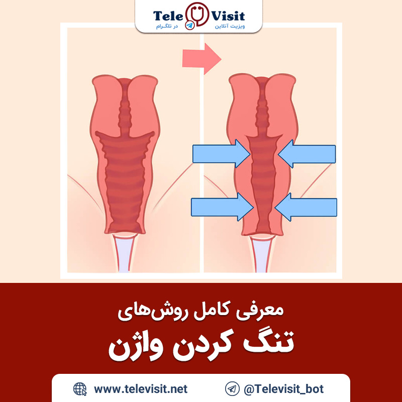معرفی-کامل-روش-های-تنگ-کردن-واژن-تله-ویزیت